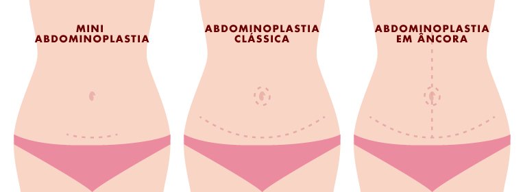 cicatriz da abdominoplastia 