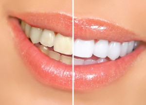 Clareamento dos dentes: você sabe como funciona?