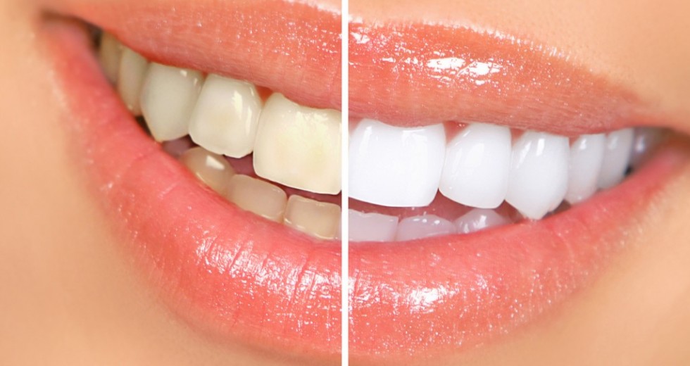Clareamento dos dentes: você sabe como funciona?