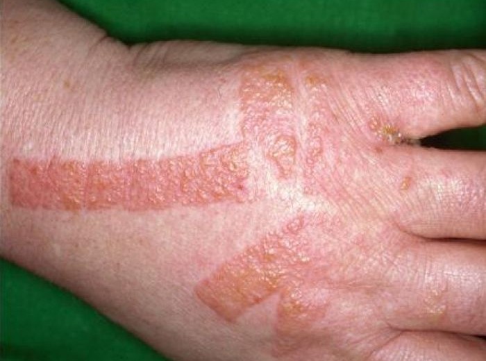 Alergia nas mãos: como identificar as possíveis causas