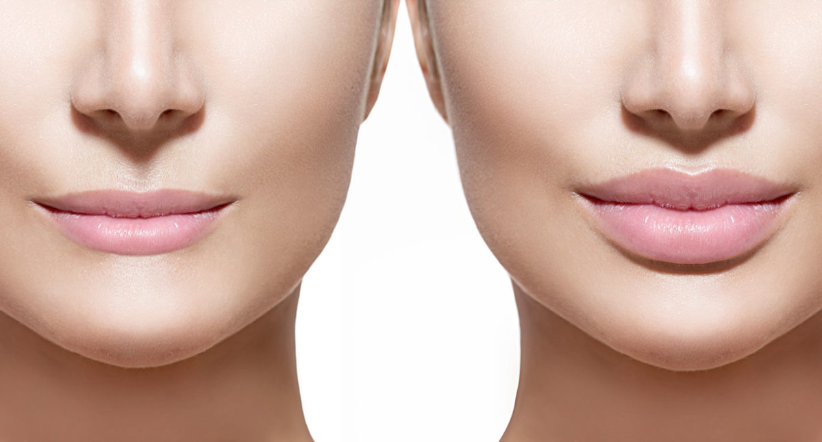 antes e depois do preenchimento nos lábios